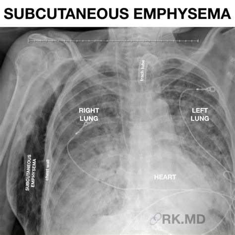 Subcutaneous Emphysema RK MD