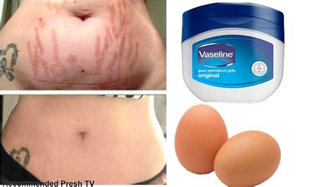 World S Best Remedy For Stretch Mark Removing How To Get Rid Of