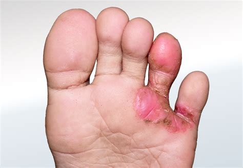 Bacterial Infection Relieve Foot Pain And Leg Pain