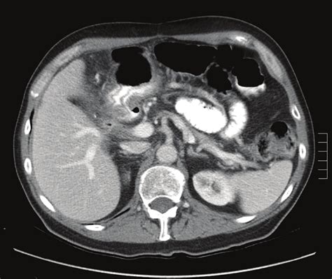 Abdominal Tumor Ct Scan