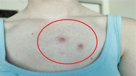 How To Get Rid Of Chest Acne Fast At Home Youtube