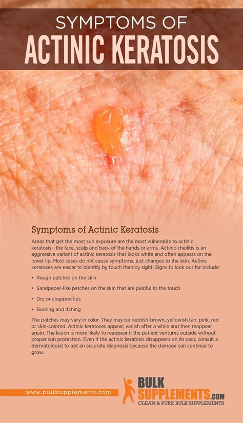 What Is Actinic Keratoses Usefull Information