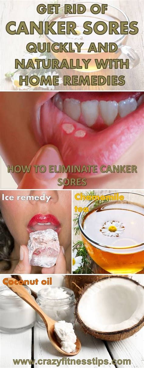 Quick Way To Get Rid Of Mouth Ulcers Anna Blog