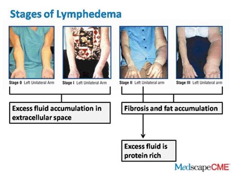 Lymphedema In Breast Cancer Survivors Update On Early Detection And