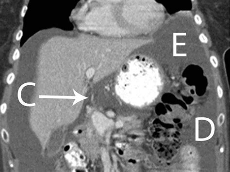 Peritoneum And Retroperitoneum Radiology Key