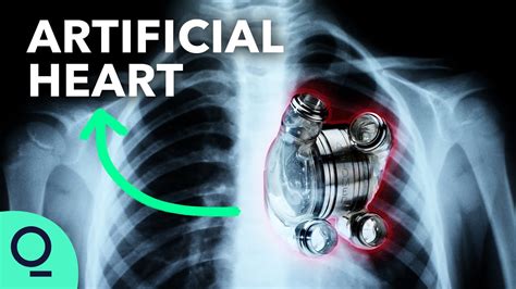 Permanent Artificial Hearts Are Closer Than You Think Youtube