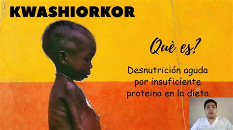 Kwashiorkor Nutrición Youtube