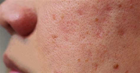 What Causes Rough Uneven Skin Texture And 5 Ways To Make Your Skin