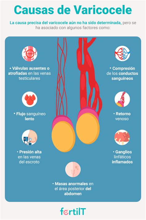 Varicocele Qué Es Síntomas Causas E Infertilidad