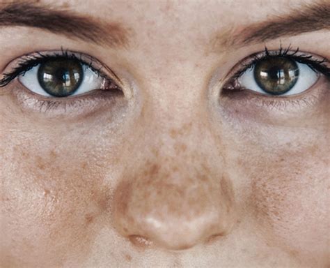 Expert Tips Pigmentation Around Eyes Remedies Pigmentation Around