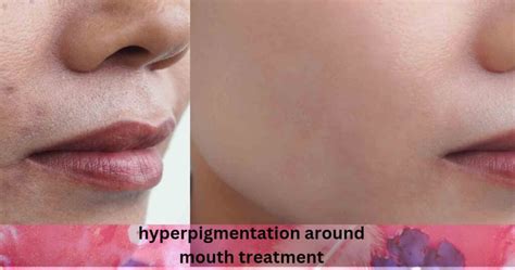 Decoding Hyperpigmentation Around The Mouth Causes And Solutions