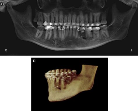 Autotransplantation Of Immature Third Molars And Orthodontic Treatment