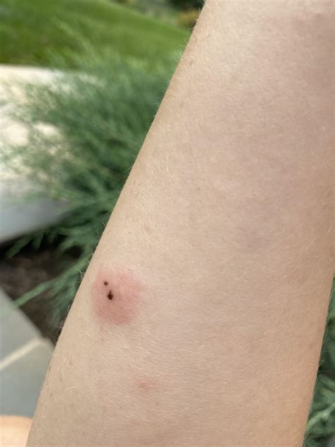 Is This A Brown Recluse Bite 3 Days In After Cleaning Off Some Gunk