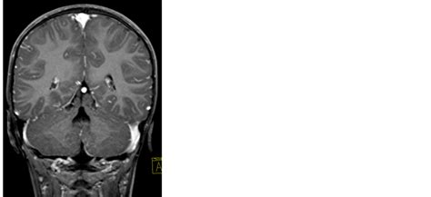 Ct And Mr Imaging Findings In The Joubert Syndrome A