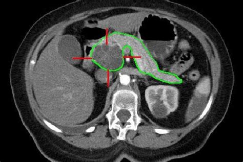 Doctors commonly order ct scans if they think a person may have pancreatic cancer. Penn researchers: Targeting enzyme could slow spreading in ...