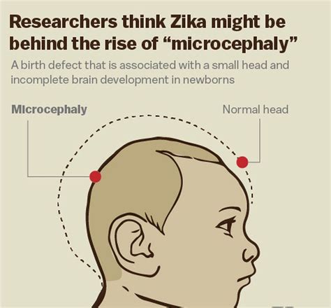 Zika has been found in a woman's cervical mucus up to 11 days after her signs and symptoms start. NBRC researchers decipher how Zika virus causes ...