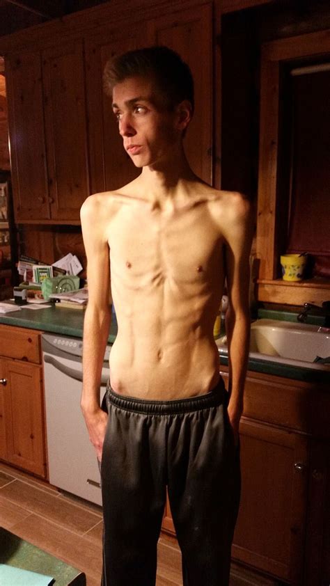 Teen Winning Anorexia Battle But Fears Remain Local News Wcfcourier Com