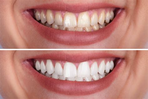 Qué manchan nuestros dientes DM Odontológica