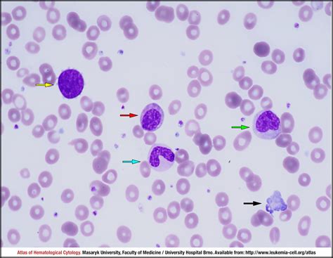 Overt Primary Myelofibrosis Cell Atlas Of Haematological Cytology
