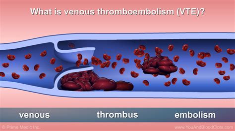 Preventing And Treating Venous Thromboembolism Vte
