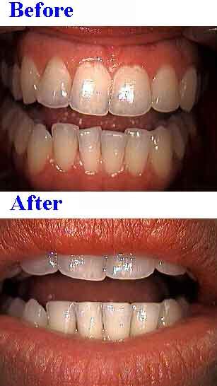 Sculpting For Tooth Length And To Reshape Teeth