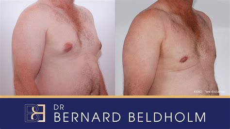 Revision Gynecomastia Surgery Before After This Patient Saw Dr Beldholm After Having His