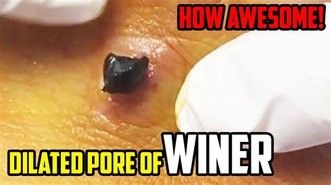 Most Popular Blackheads And Pimples On Youtube 👍👍👍👍 Youtube