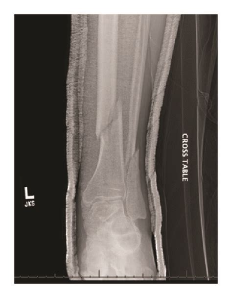 Preoperative Ap And Lateral Radiographic Images Of The Left Leg