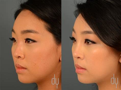 Non Surgical Nose Job Before And After Asian Else Tabor