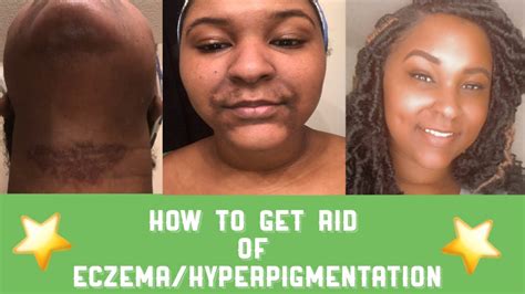 Skin Routine To Get Rid Of Eczemahyperpigmentation Youtube