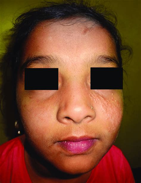 A Skin Colored Plaque And Papules On The Left Side Of The Face Along