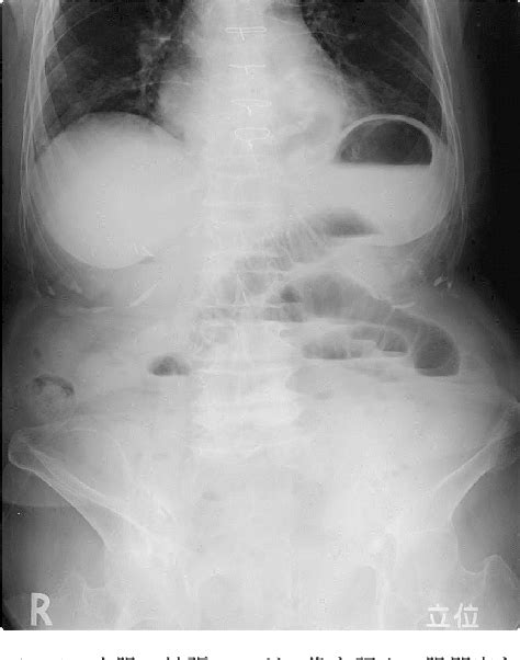 Figure 1 From A Case Of Incarcerated Obturator Hernia Performed Non