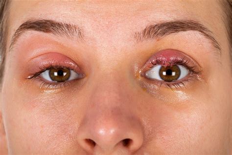 Bump On Lower Eyelid