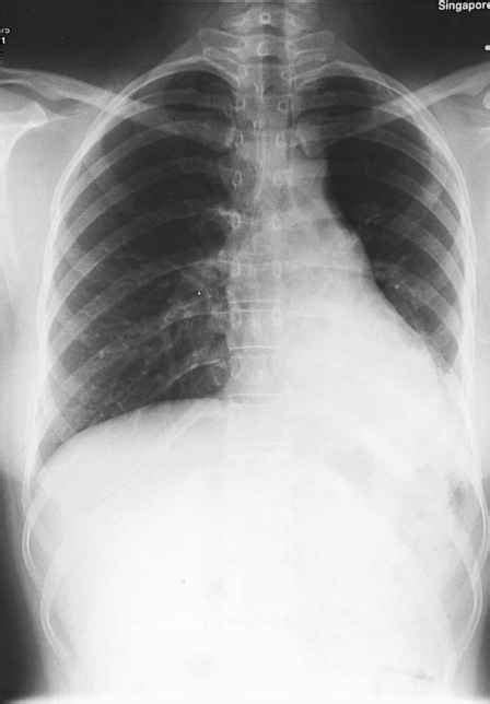 Case 68 Left Pleural Effusion And Lytic Lesion In The Left Third Rib