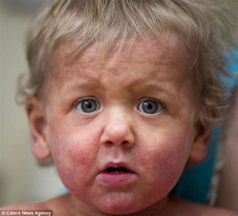 Boy Suffers From Rare Diffuse Cutaneous Mastocytosis Which Leaves Him