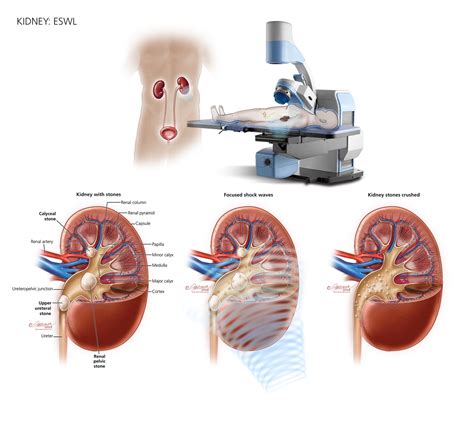 How Are Kidney Stones Treated Urology Care Foundation