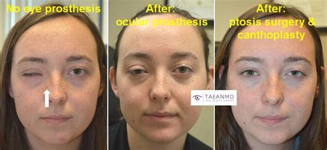 Prosthetic Eye And Socket Surgery Before And After Photos Taban Md