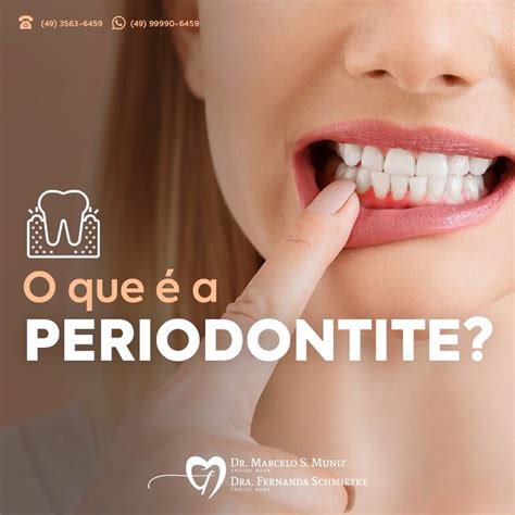 O que é a periodontite Odonto Muniz