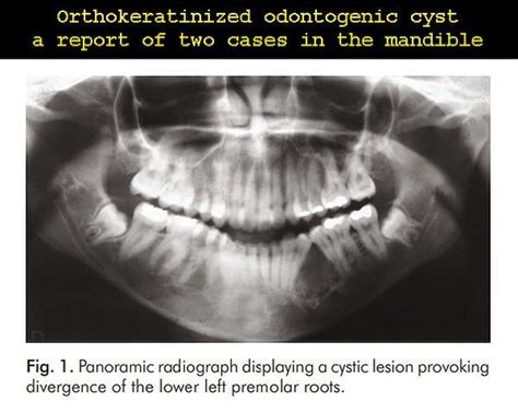 Pdf Orthokeratinized Odontogenic Cyst A Report Of Two Cases In The