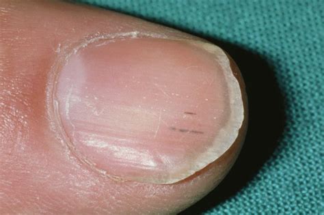 The spot is often seen with brittle toenails with a yellowish to discover a black spot on toenail can raise alarms, both for your health and your vanity. Black Spot On Toenail Near Cuticle - Nail Ftempo
