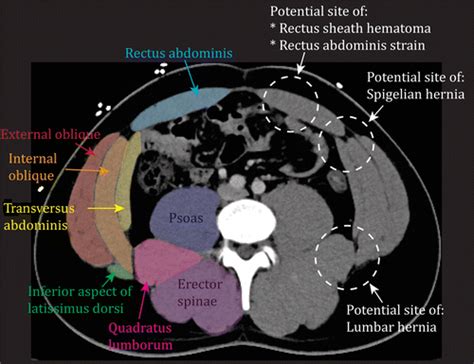 Dont Forget The Abdominal Wall Imaging Spectrum Of Abdominal Wall