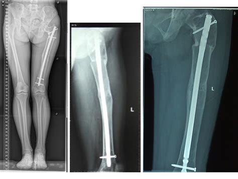 Figure 3 From Double Level Osteotomy And One Stage Reconstruction With