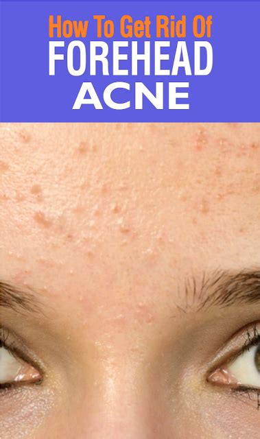 Forehead Acne Causes Treatment And Prevention Tips Wellness Magazine
