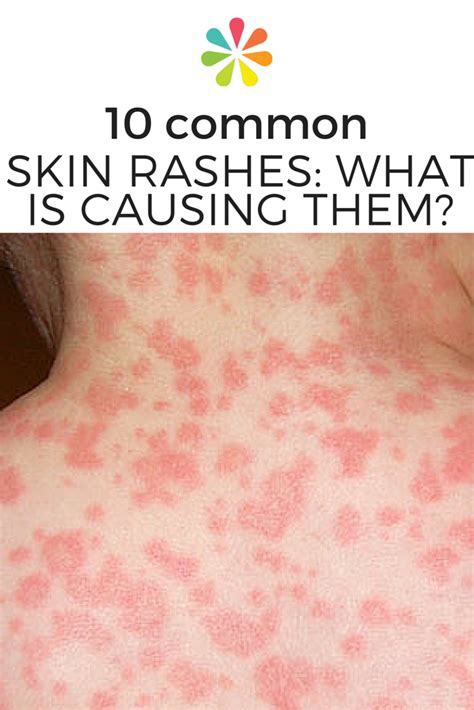 10 Most Common Types Of Skin Rashes Daily Health Valley Images And