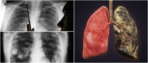 Metástasis Pulmonares Qué Es Síntomas Recomendaciones Atención Méd