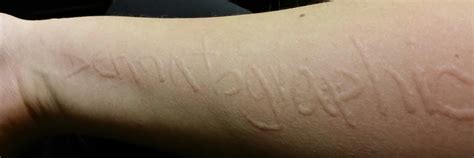 Happy Valentines Day Dermatographia Is Awesome Skintome