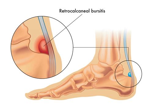Achilles Bursitis Rehab