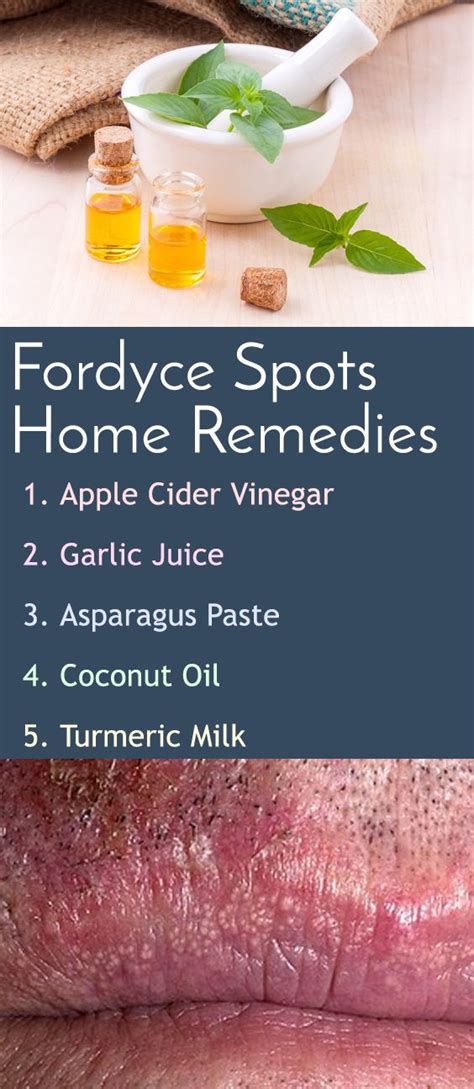 Home Remedies For Fordyce Spots On Lips Remedies With Apple Cider