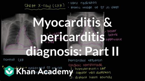 Acute pericarditis is an inflammatory process involving the pericardium that results in a clinical viral pericarditis. Diagnosis of myocarditis and pericarditis (part 2) | NCLEX ...