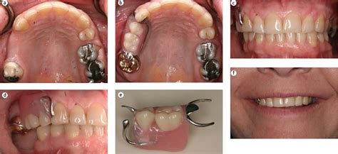 Flippers are typically intended to be a temporary solution since they can be challenging to keep in. Figure 2 from Unilateral removable partial dentures ...